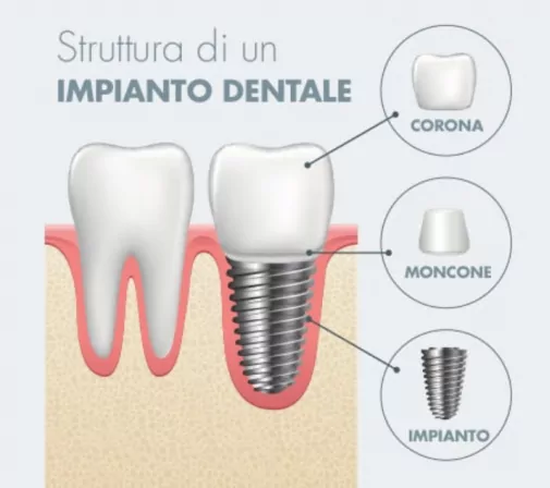 moncone implantare